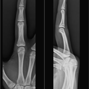 X-RAY RIGHT INDEX FINGER AP/OBLIQUE VIEW