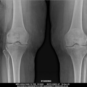 X-RAY BOTH KNEE JOINT AP/LATERAL (STANDING)