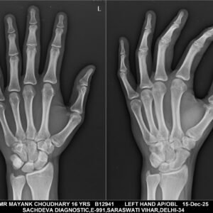 X-RAY LEFT HAND AP VIEW