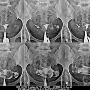 X-RAY HISTOSALPHANOGRAPHY (HSG)